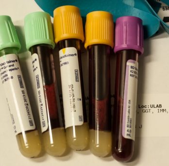 Vials of blood after a patient's blood test.
                  